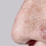 Basal cell carcinoma