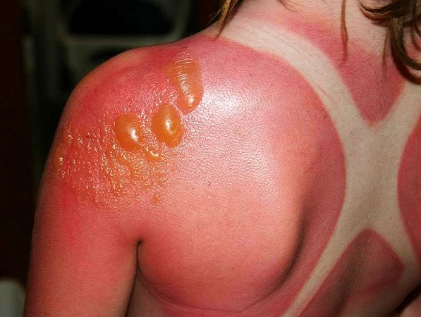 Sunburns and melanoma