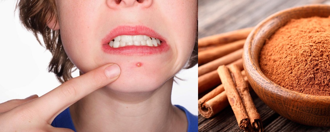 Cinnamon For Acne