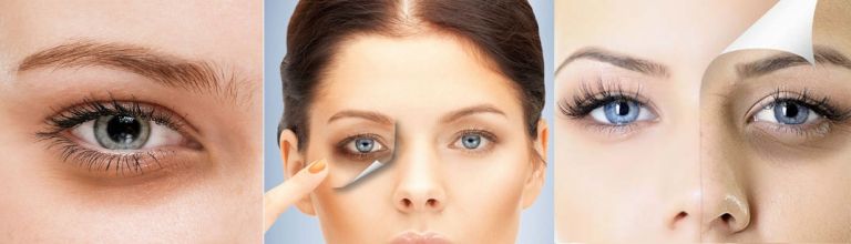 How to Remove Dark Circles Naturally