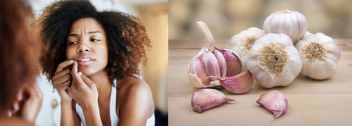 Garlic For Treating Pimples