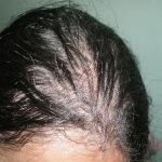 Hypothyroid Hair Fall