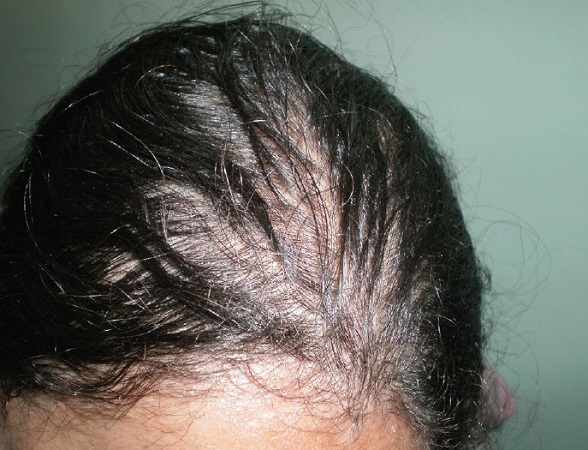 Hypothyroid Hair Fall