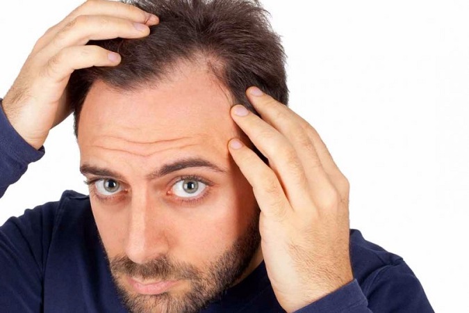 Male Pattern Baldness