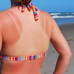 Apple Cedar Vinegar For Sun burn
