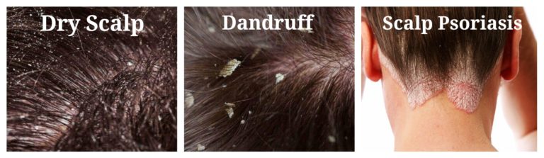 How To Get Rid Of Dandruff - FashionBuzzer.com