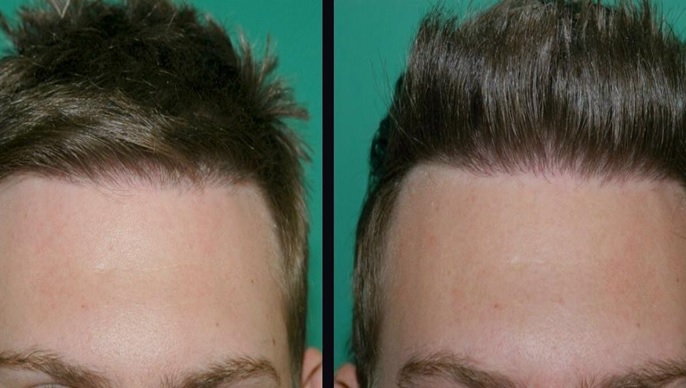 Increase Hair Density after a Haircut